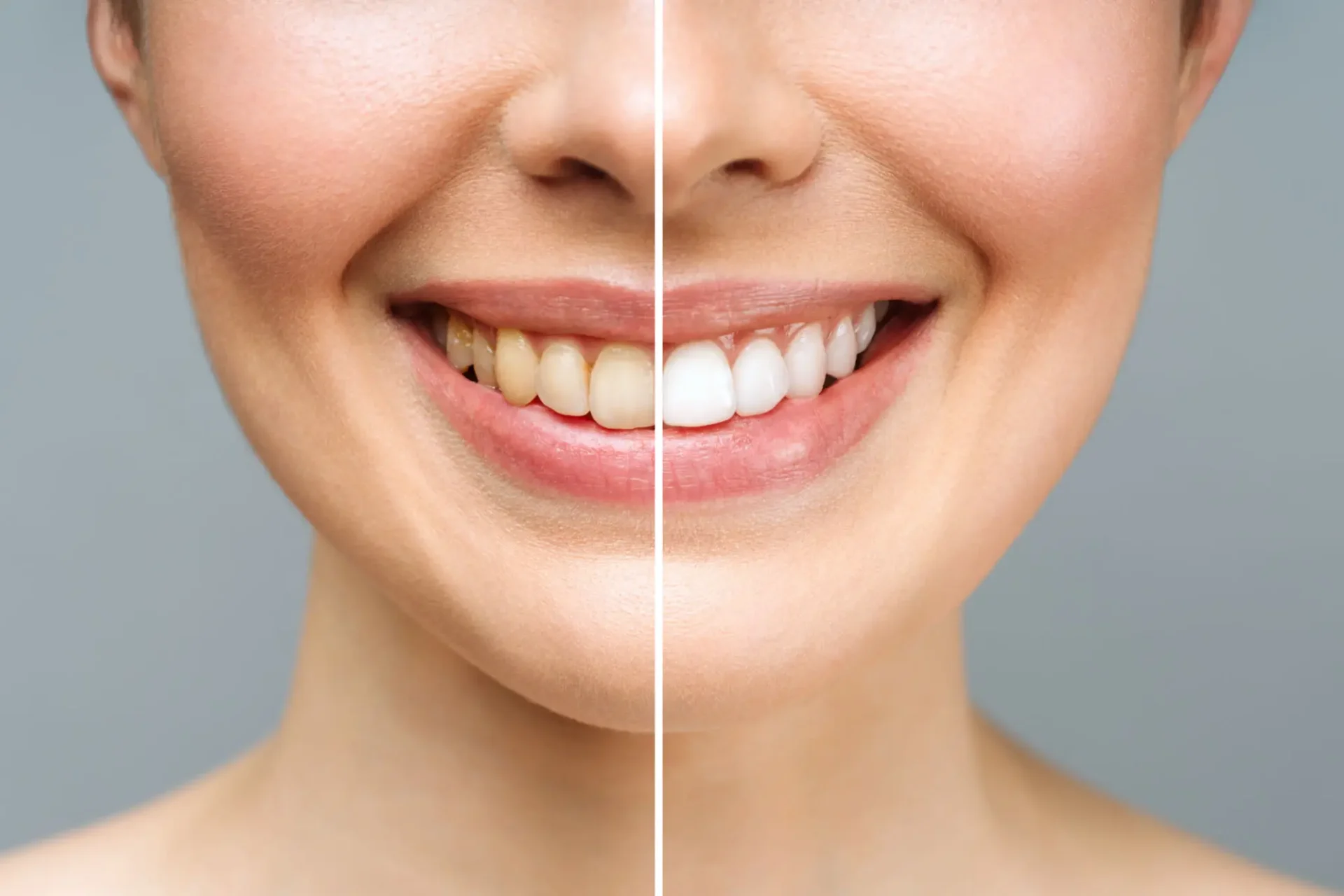 Teeth whitening comparison with smiling woman.
