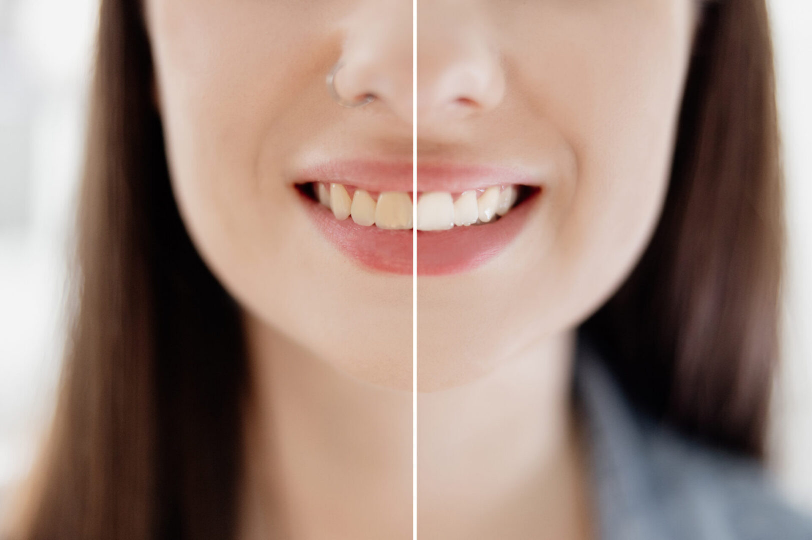 Teeth before and after whitening comparison.